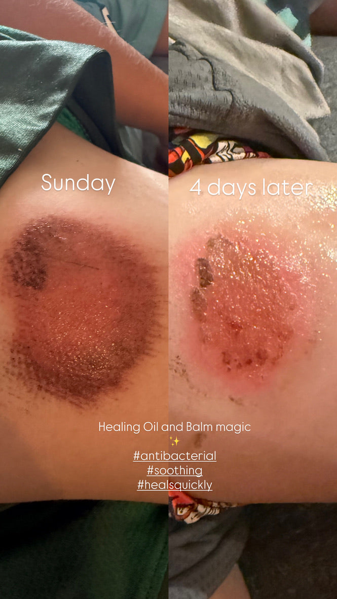 Healing Oil | Tend