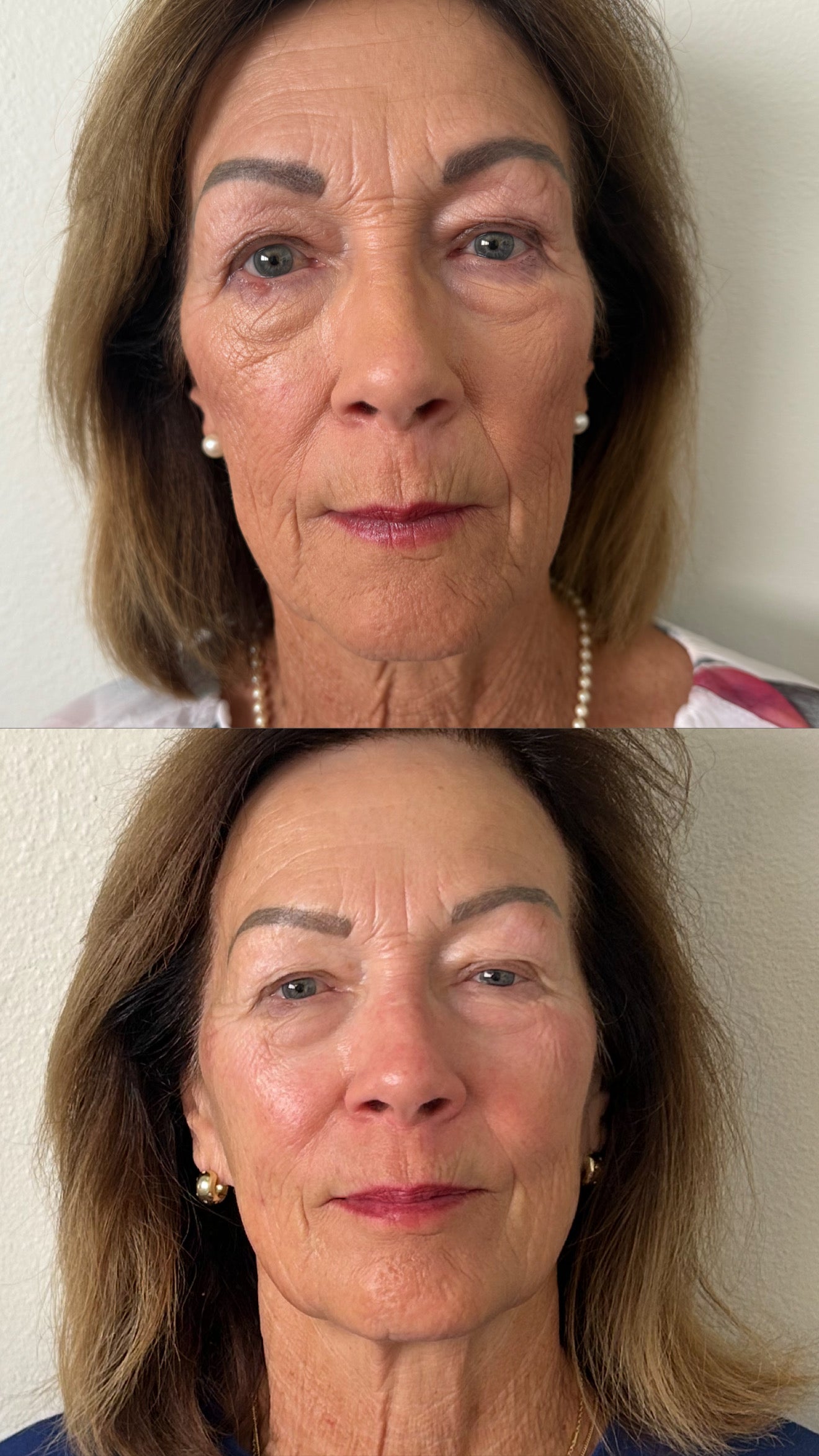3 Treatment Series Facial | CO2Lift® Carboxy Gel Treatment + Celluma Light Therapy