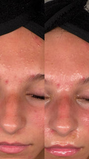 Custom Acne Facial