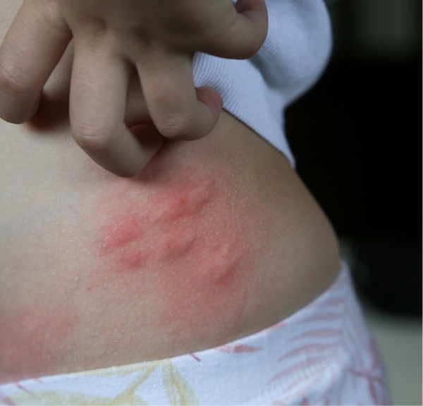 <p>Bug bites and stings</p>