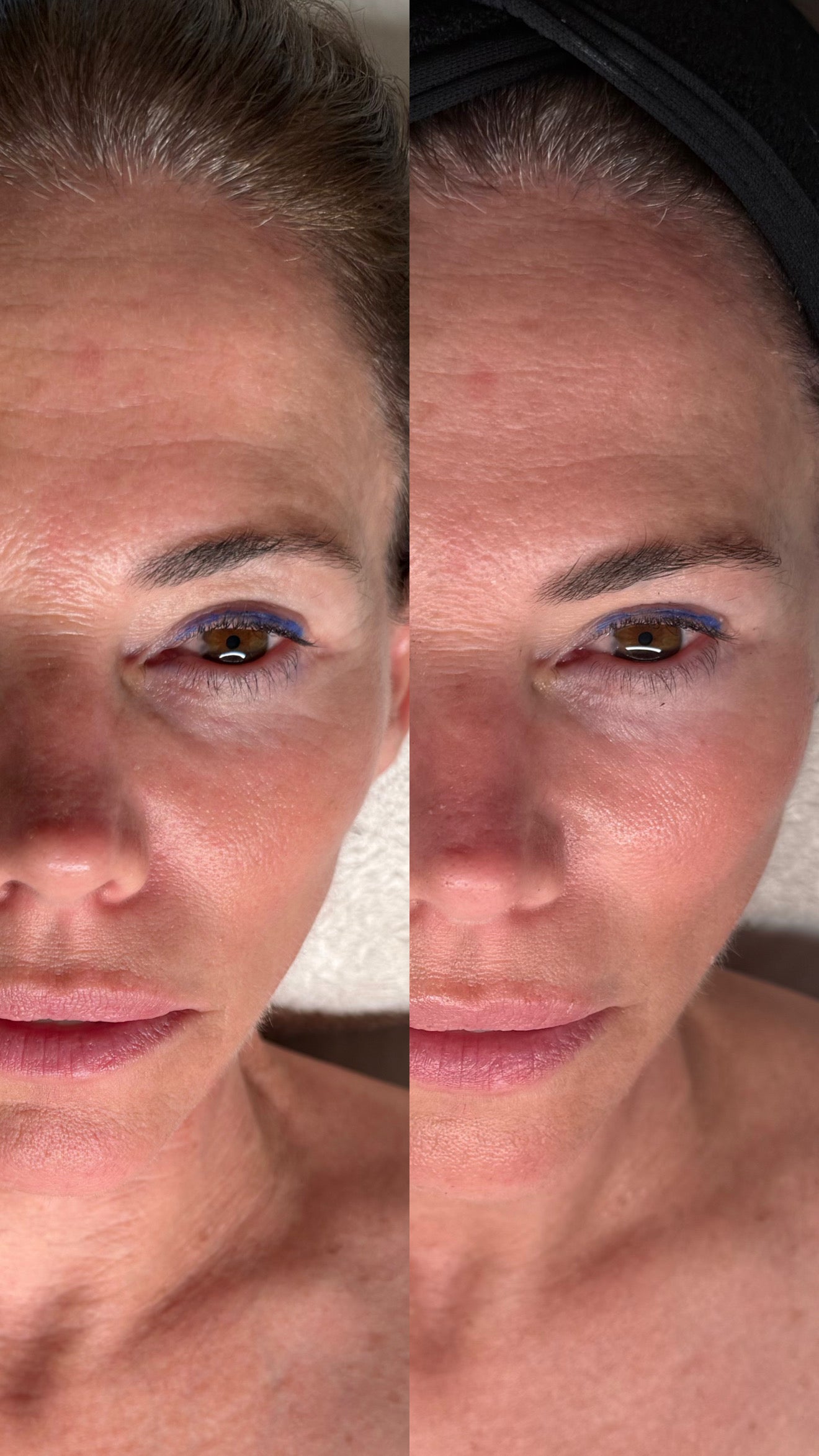 Single Session Facial | CO2Lift® Carboxy Gel Treatment + Celluma Light Therapy