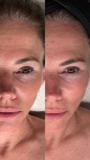 Single Session Facial | CO2Lift® Carboxy Gel Treatment + Celluma Light Therapy