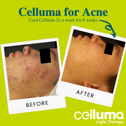 Custom Acne Facial