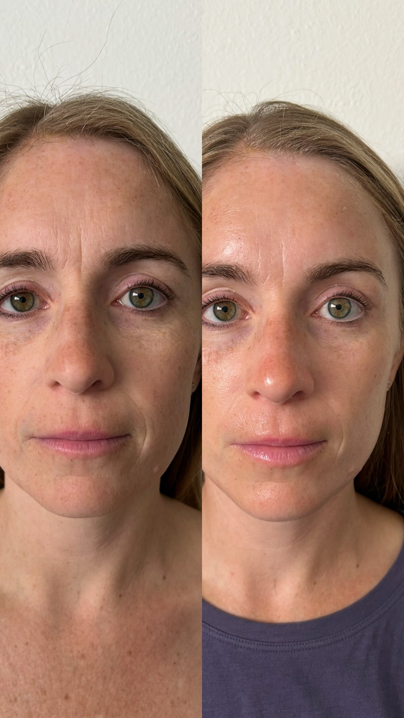 CO2 Lift At-Home Treatment Trio (3 Treatments)