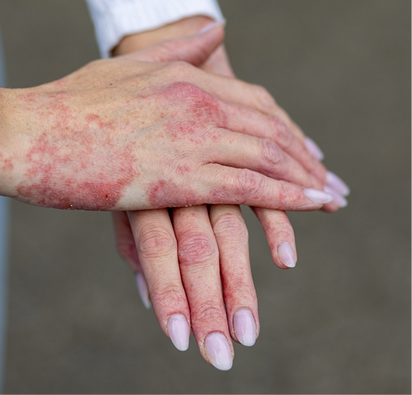 <p>Eczema and psoriasis</p>