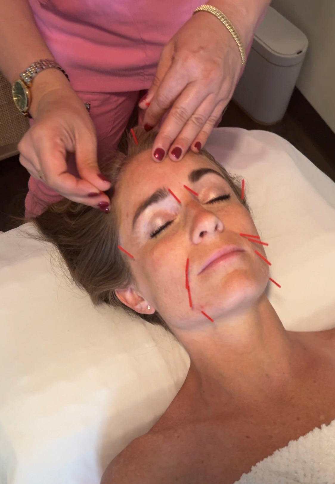 Cosmetic Acupuncture