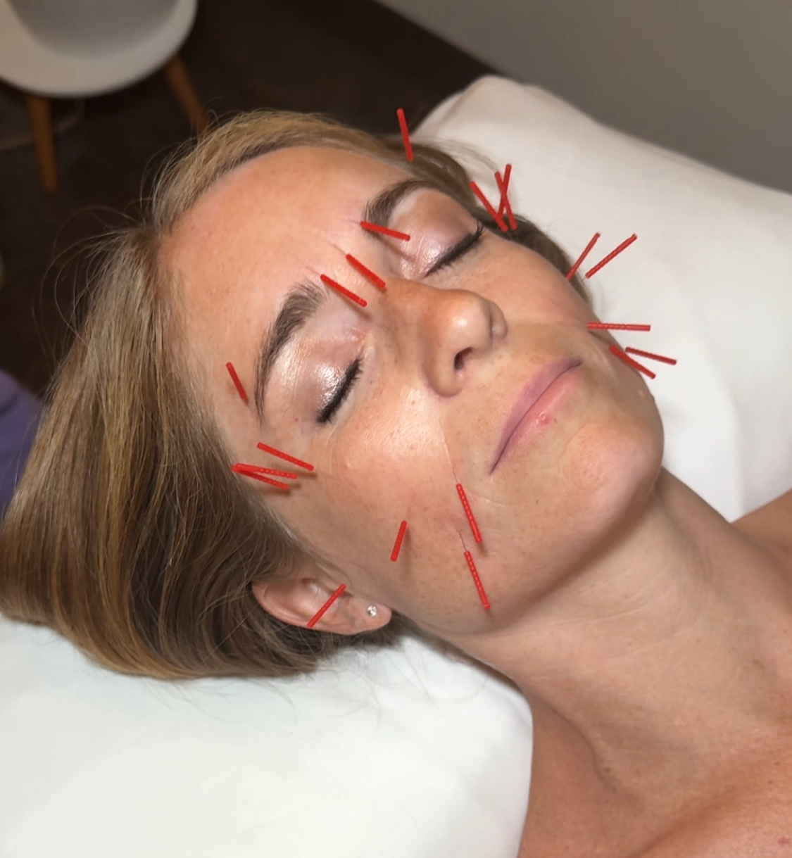 Cosmetic Acupuncture