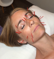 Cosmetic Acupuncture
