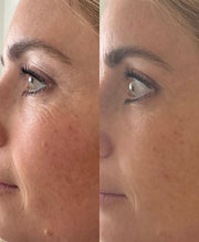 Cosmetic Acupuncture