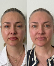 Cosmetic Acupuncture