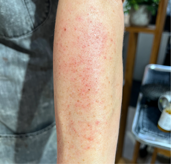 <p>Rashes and hives</p>