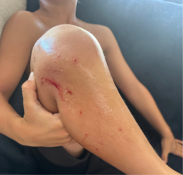 <p>Scars and scabs</p>