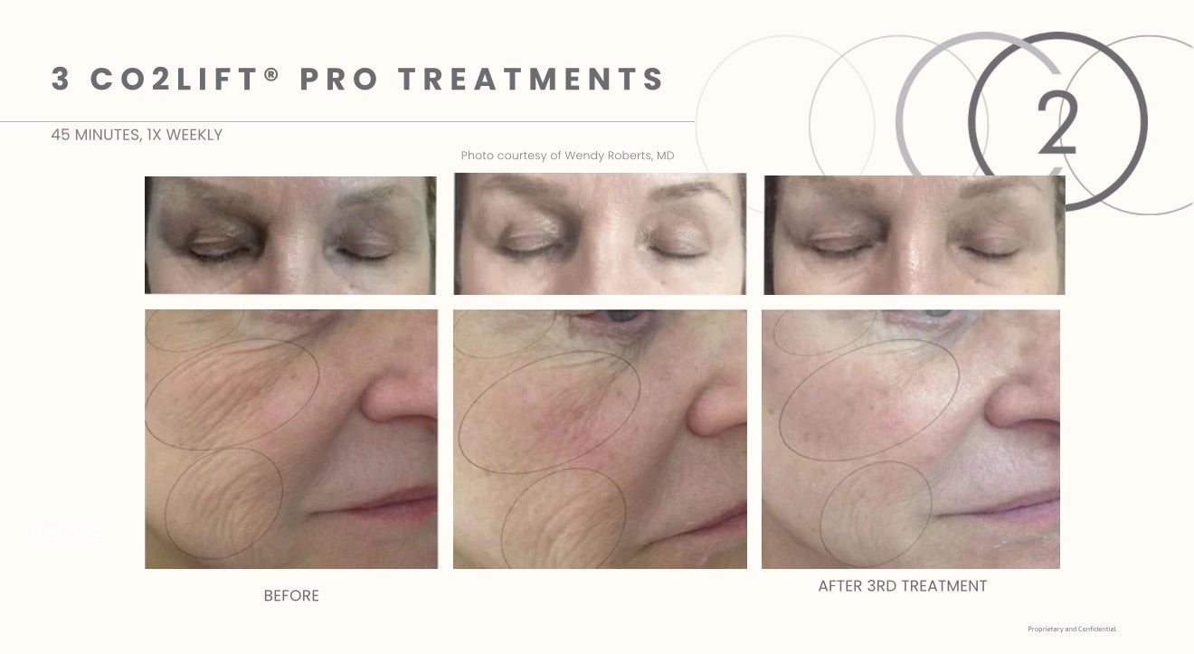 3 Treatment Series Facial | CO2Lift® Carboxy Gel Treatment + Celluma Light Therapy