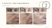 CO2 Lift At-Home Treatment Trio (3 Treatments)
