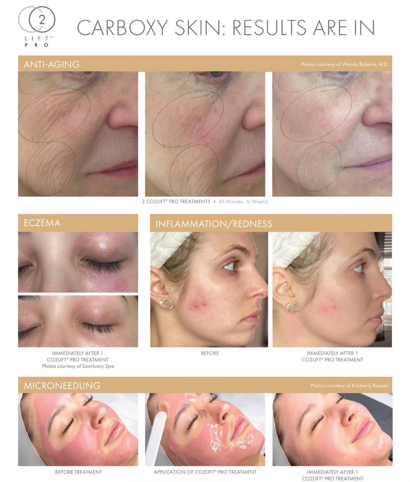 3 Treatment Series Facial | CO2Lift® Carboxy Gel Treatment + Celluma Light Therapy