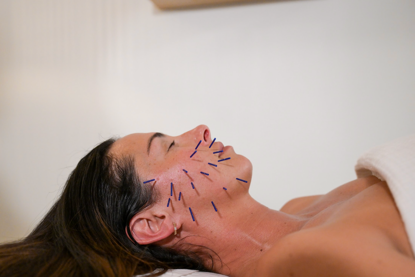 Cosmetic Acupuncture
