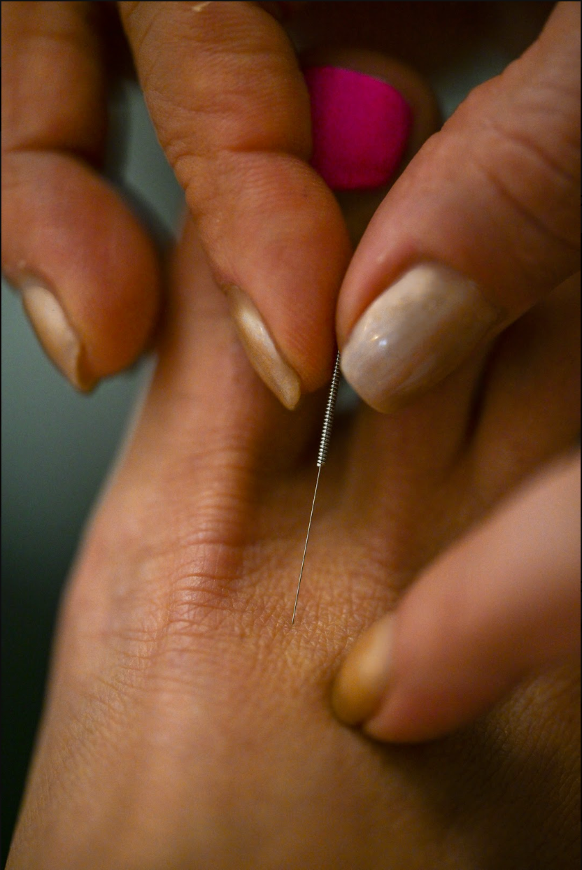 Acupuncture