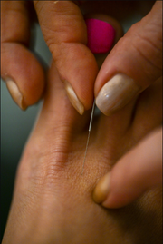 Acupuncture