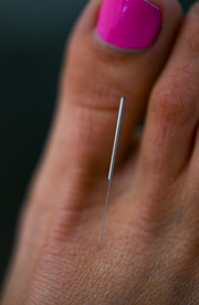 Acupuncture