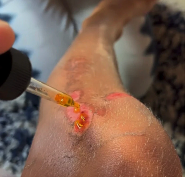 <p>Skin reactions</p>