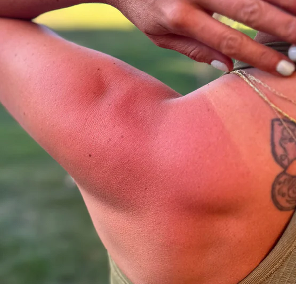 <p>Sunburns</p>