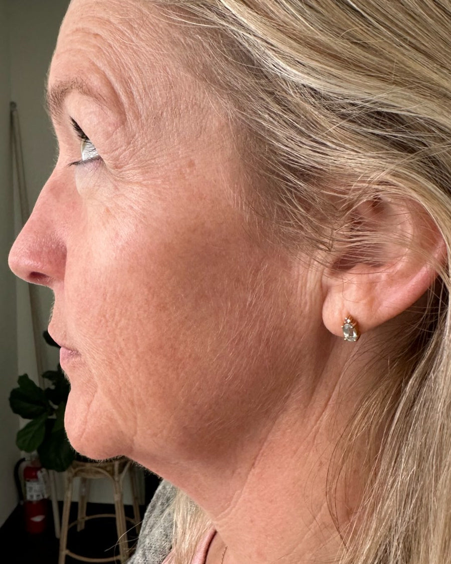 Katie, before, side profile