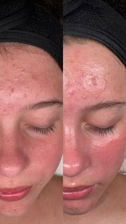 Custom Acne Facial