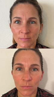 3 Treatment Series Facial | CO2Lift® Carboxy Gel Treatment + Celluma Light Therapy